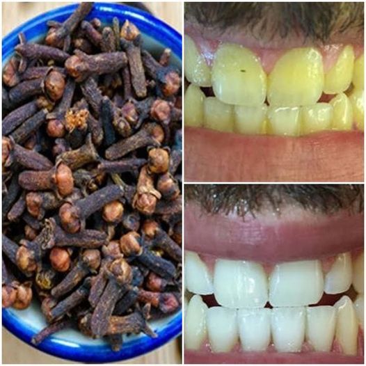 Harnessing the Power of Cloves: A Natural Remedy for Nail Fungus